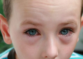 Zapalenie spojówek – jak rozpoznać objawy?