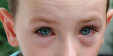 Zapalenie spojówek – jak rozpoznać objawy?