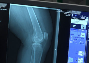 W wyniku pandemii tysiące chorych na osteoporozę pozostają bez pomocy. Lekarze i pacjenci apelują o proste zmiany umożliwiające diagnostykę i leczenie