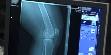 W wyniku pandemii tysiące chorych na osteoporozę pozostają bez pomocy. Lekarze i pacjenci apelują o proste zmiany umożliwiające diagnostykę i leczenie