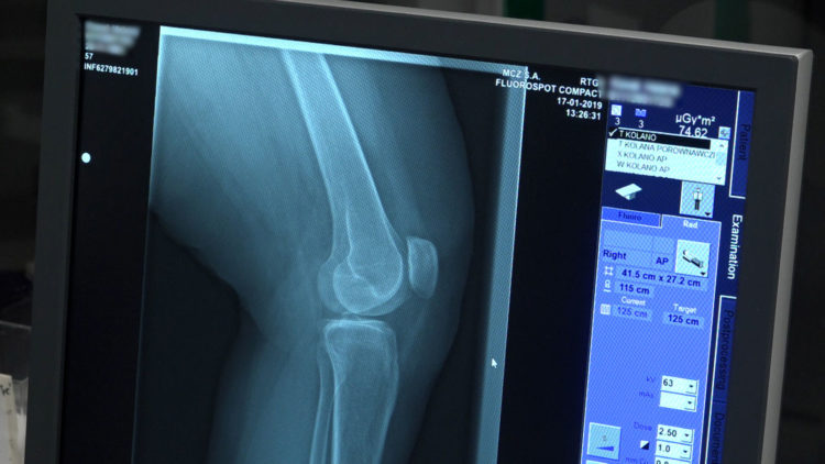 W wyniku pandemii tysiące chorych na osteoporozę pozostają bez pomocy. Lekarze i pacjenci apelują o proste zmiany umożliwiające diagnostykę i leczenie